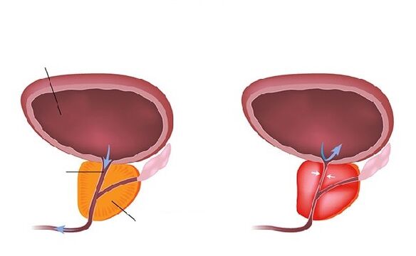 normaalne ja põletikuline eesnääre